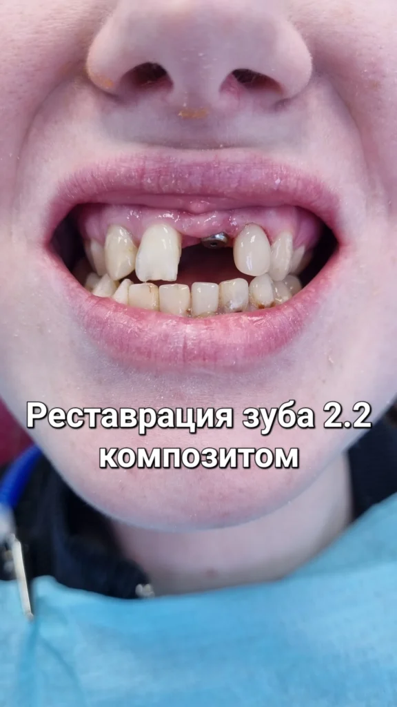 Улыбка с имплантом и художественной реставрацией