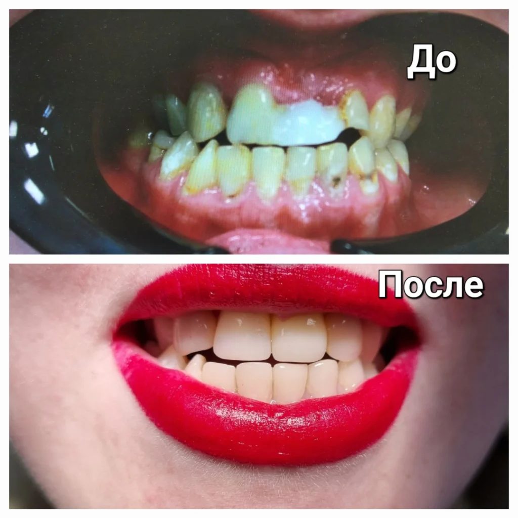 Улыбка с имплантом и художественной реставрацией