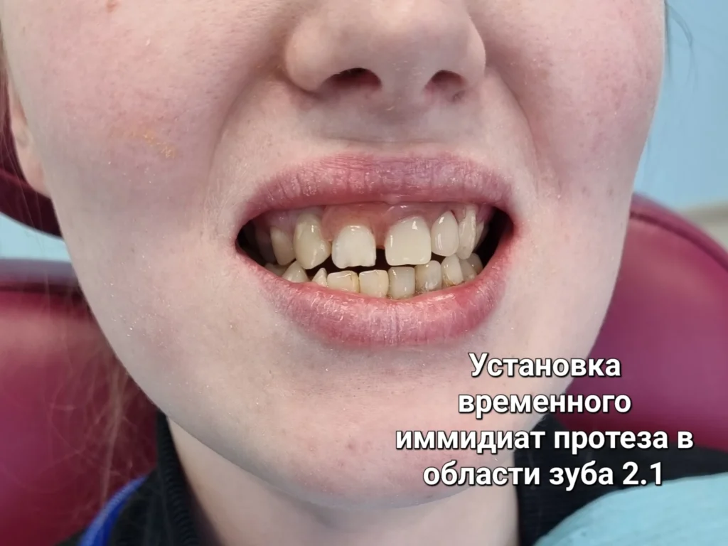 Улыбка с имплантом и художественной реставрацией