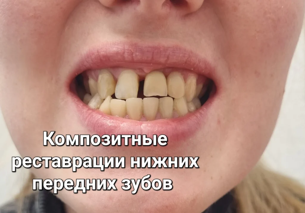 Улыбка с имплантом и художественной реставрацией