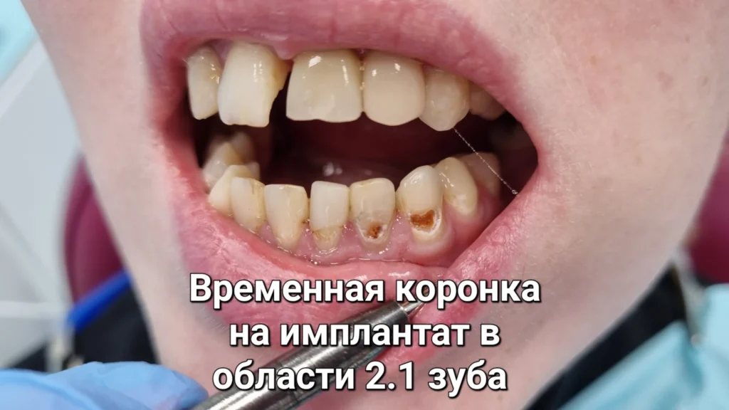 Улыбка с имплантом и художественной реставрацией
