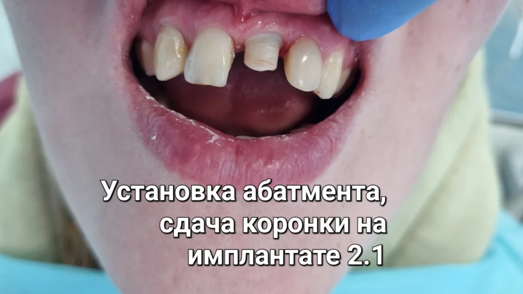Улыбка с имплантом и художественной реставрацией