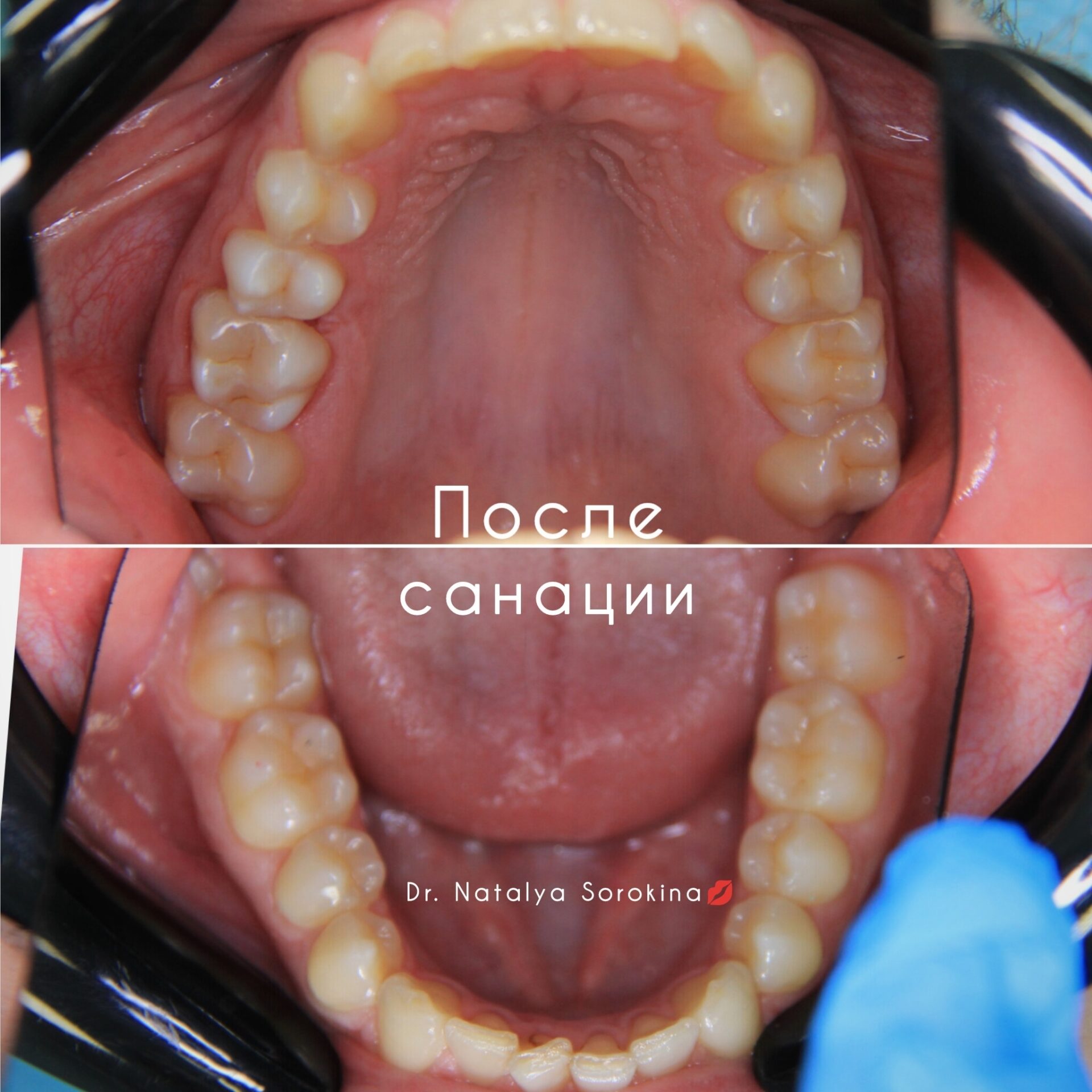 После: Комплексная санация полости рта