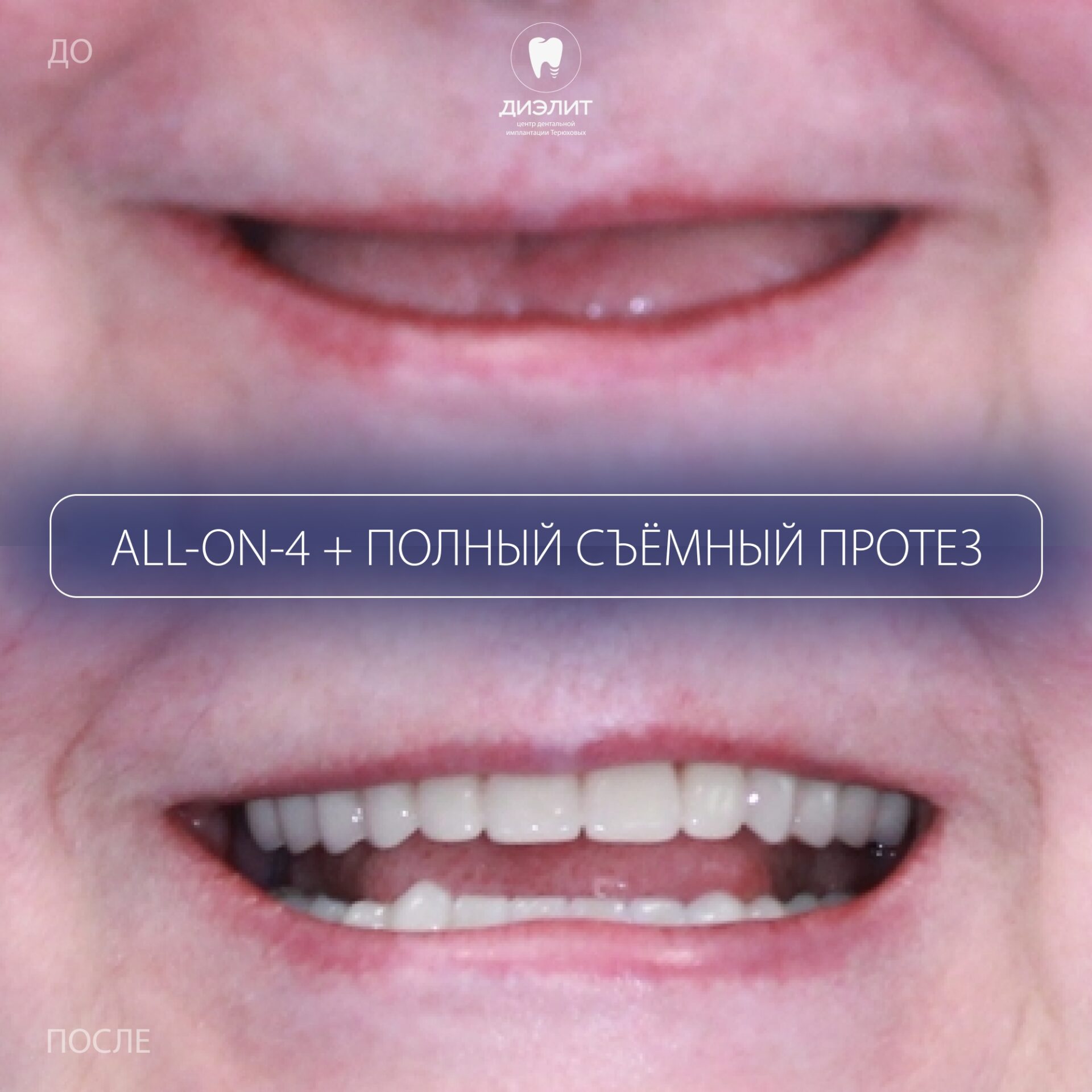 До: Полное восстановление зубов на имплантах All-on-4