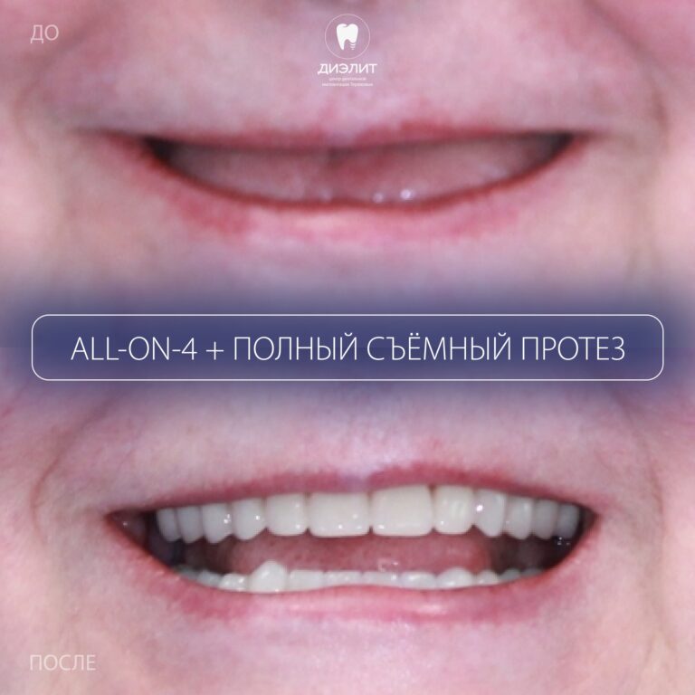 До: Полное восстановление зубов на имплантах All-on-4