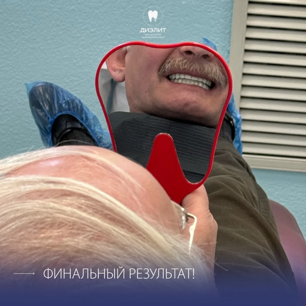 Имплантация верхней и нижней челюсти