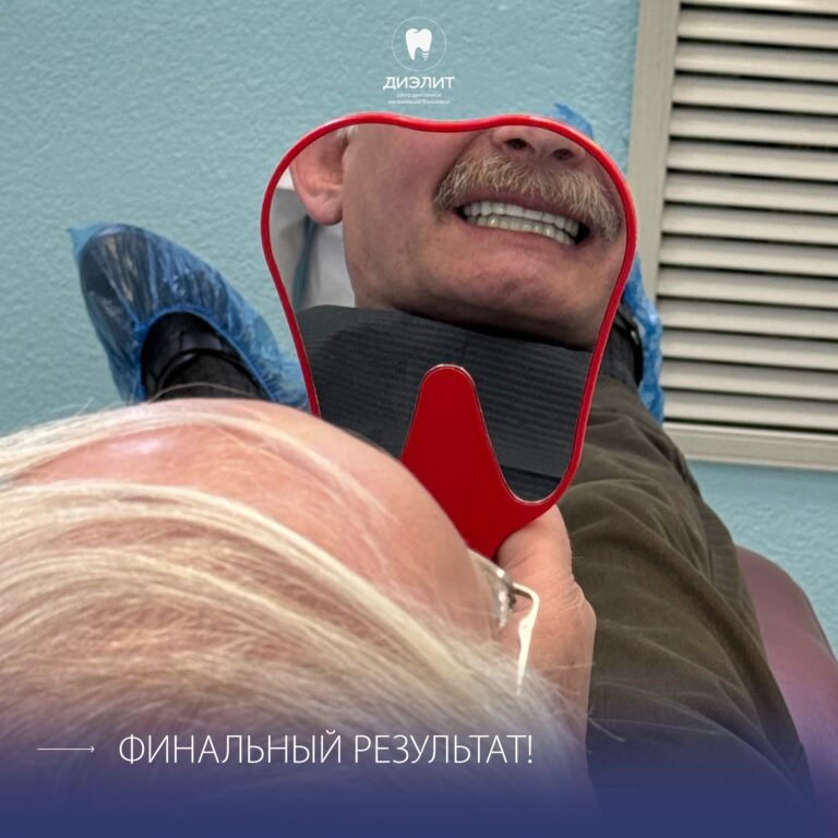 До: Имплантация верхней и нижней челюсти