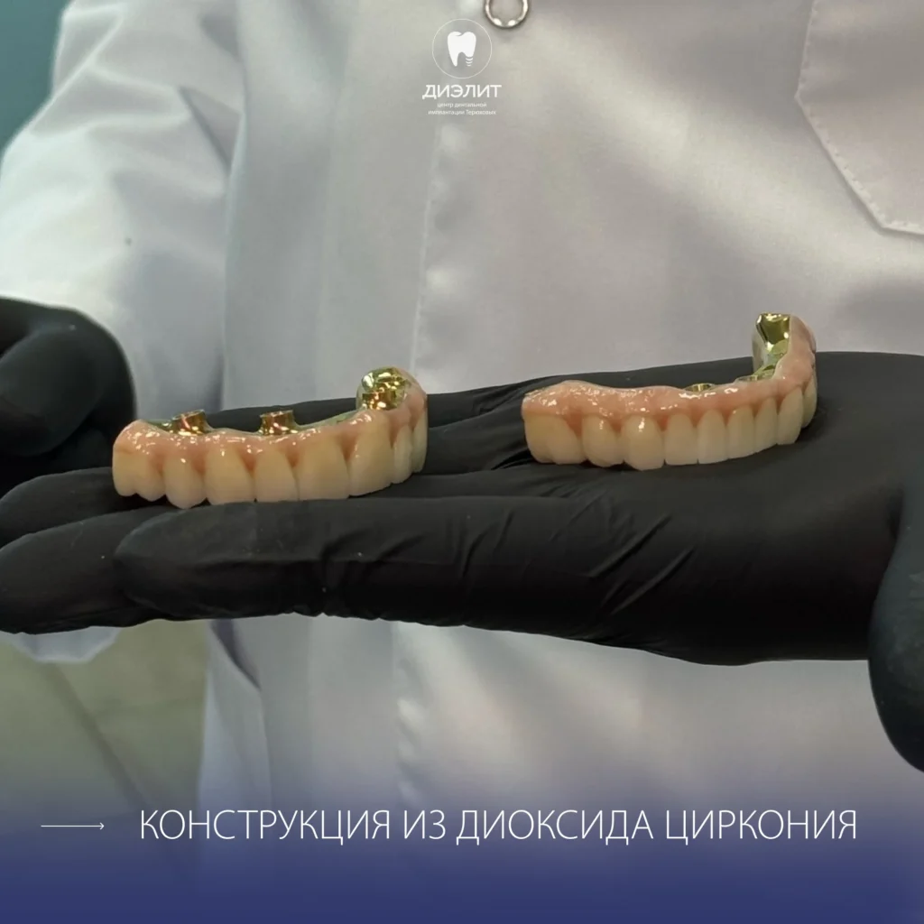 Имплантация верхней и нижней челюсти