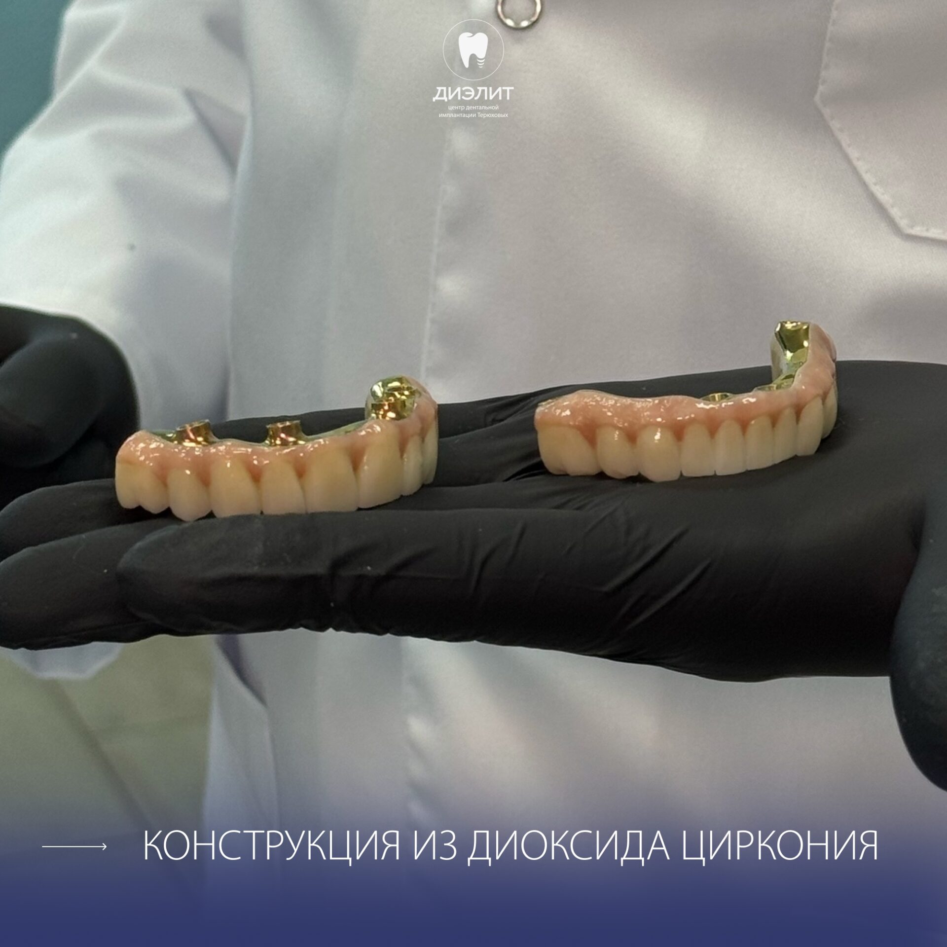 После: Имплантация верхней и нижней челюсти