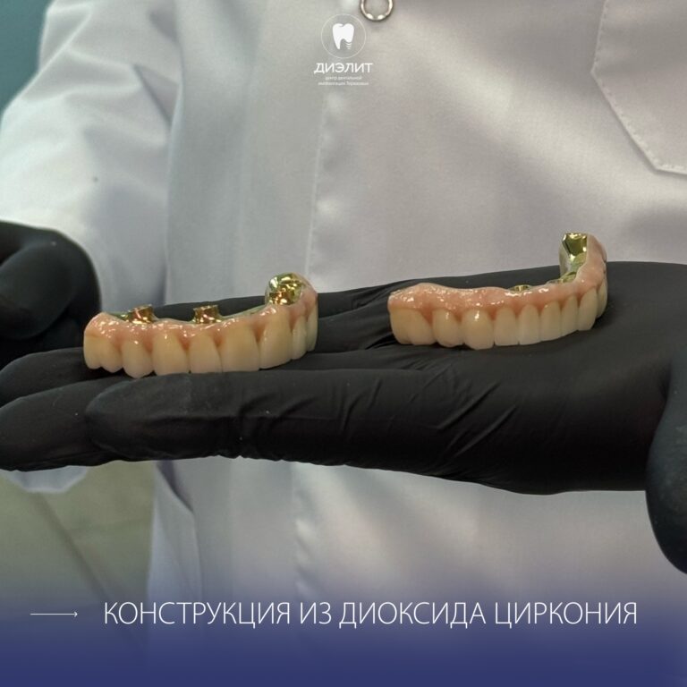После: Имплантация верхней и нижней челюсти