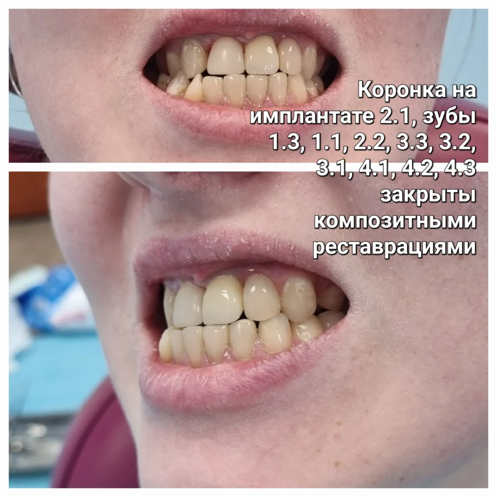Улыбка с имплантом и художественной реставрацией