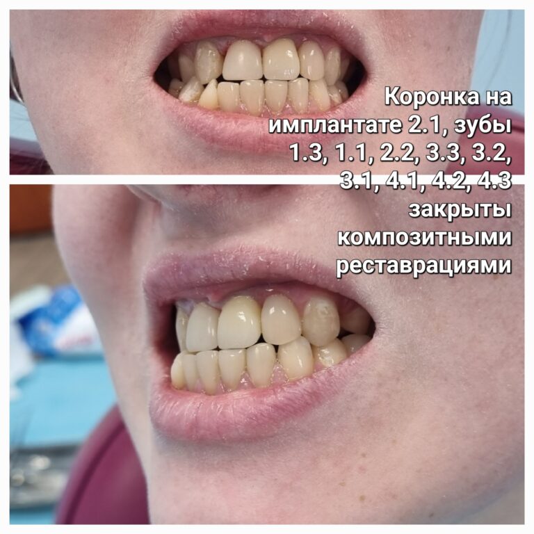 До: Улыбка с имплантом и художественной реставрацией