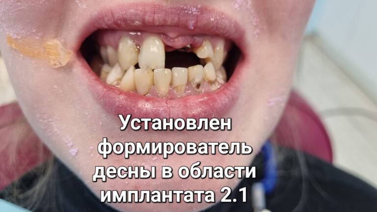 После: Улыбка с имплантом и художественной реставрацией